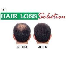 To get the best results, use products every day. The Hair Loss Solution Home Facebook