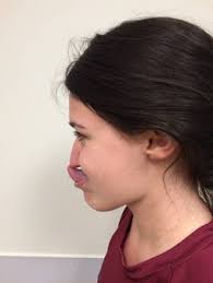 Joint hypermobility/EDS in ME/CFS