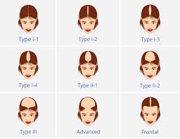 She or he will observe the pattern of hair loss, check for signs of inflammation or infection, and possibly order blood tests to investigate other possible causes of hair loss, including hyperthyroidism, hypothyroidism, and iron deficiency.unless there are signs of excess androgen activity (such. Female Pattern Hair Loss