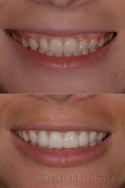 Laser Gum Lift Calgary Dentistry Gum Surgery Emergency Dentist Dental