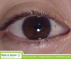 A Pinguecula Is A Yellow Bump On The Eye Caused By Thickening Of The Conjunctiva That Covers The White Of The Eye Pingueculae Health Facts Old People Doctor