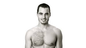 Uneven chest hair is normal. Hair Transplants Using Body Hair Dr Bayer Clinics