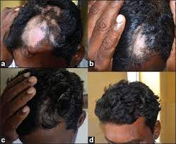 If the unusual color of the skin worries you. Indian Journal Of Dermatology Venereology And Leprology Alopecia Areata Vitiligo Overlap Syndrome An Emerging Clinical Variant