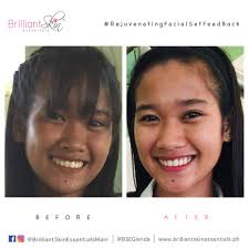 BEFORE and AFTER using Brilliant Rejuvenating Facial Set. 🔥 Kitang-kita naman sa before photo ni Girl na ang dark ng skin nya, but now ang glow at puti na nya di ba!