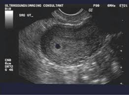 Racgp Early Pregnancy Bleeding