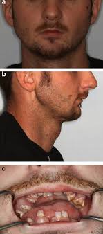 Secondary reconstruction of panfacial fractures