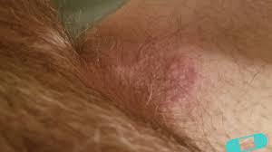 Image result for Intertrigo under breasts