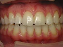 How do i prevent baby bottle tooth decay? Invisalign Helps Open Bites From Tongue Thrust Stovall Cheng Dds Pllc