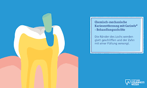 Karies Behandeln Mit Und Ohne Bohren Stiftung Gesundheitswissen