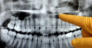 Image result for dental cancer