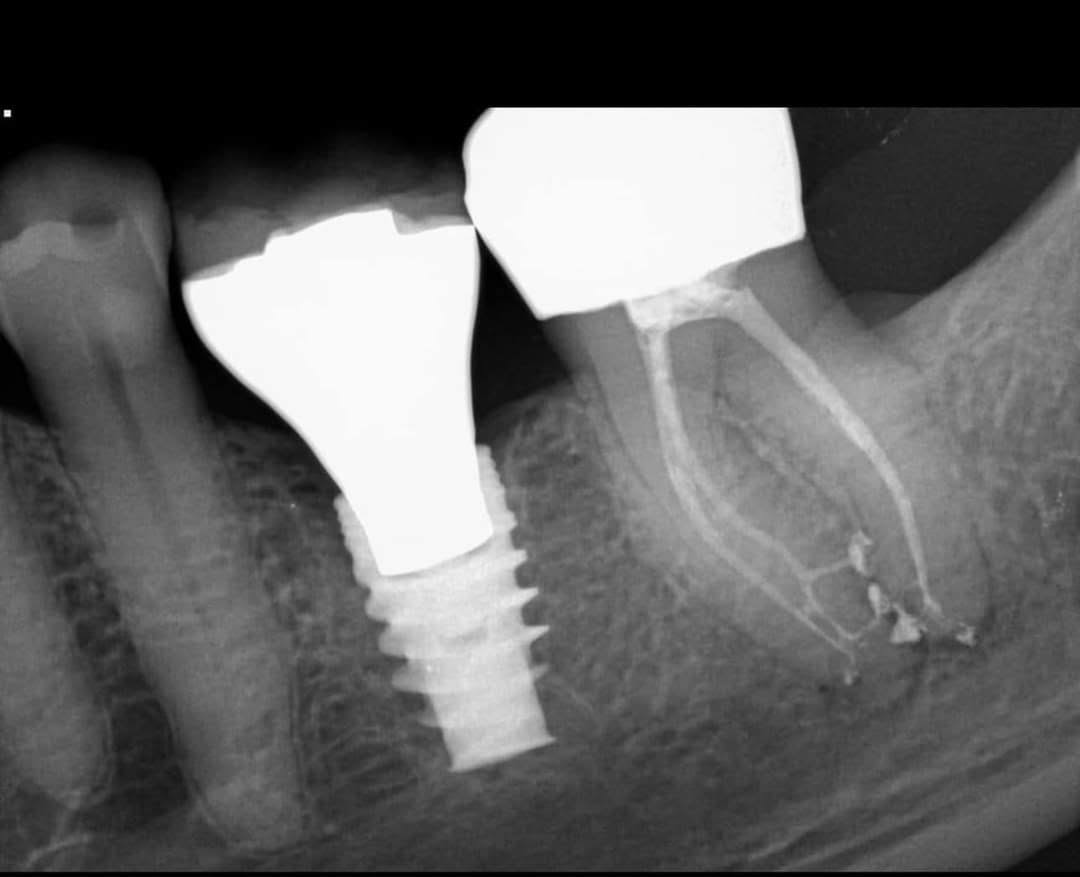 Dental Implants product image