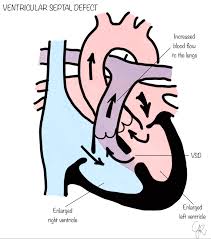 Image result for Ventricular Septal Defect