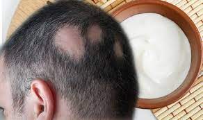 It is found in cayenne peppers and plays a vital role in hair growth. Hair Loss Treatment Apply Capsaicin Cream To Treat Alopecia Express Co Uk