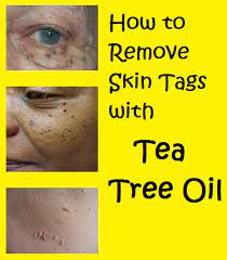 How To Remove Skin Tags With Tea Tree Oil Skin Tag Removal Oils For Skin Skin Tag