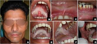 We did not find results for: Oral Submucous Fibrosis A Contemporary Narrative Review With A Proposed Inter Professional Approach For An Early Diagnosis And Clinical Management Journal Of Otolaryngology Head Neck Surgery Full Text