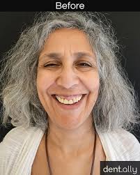 Meet Mary Tabone, who travelled to Dent Ally India for a complete Smile  Makeover and left with a brighter, more confident, and naturally beautiful  smile! Her smile transformation was crafted with: ✓