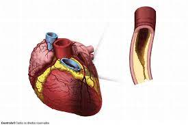 O enfarte do miocárdio é a designação dada a um ataque cardíaco. Infarto Do Miocardio Sinais Sintomas E Doencas Abcmed