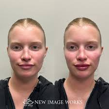 Chicago LIPS•FILLER•BOTOX•PRF