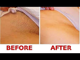 1 preventing ingrown hairs while shaving. How To Get Rid Of Pubic Ingrown Hairs