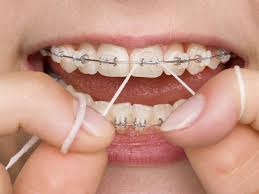 Seniors often have a lot of dental work because they didn't get fluoride or good oral care when they were kids. What Happens If You Have Braces And Don T Brush Your Teeth