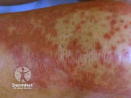 Image result for dermatitis contacta allergica