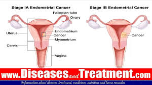 Another option is radiation therapy with powerful energy. Cancer Of The Uterus Uterine Cancer Or Endometrial Cancer Causes Symptoms Treatment Youtube