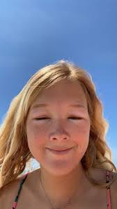 Katelyn went from battling a rare condition, lymphangiectasia, to riding  the waves at the NATIONAL SCHOLASTIC SURFING ASSOCIATION (NSSA) National  Championships! Thanks to a new groundbreaking surgical procedure developed  at Nemours Children's