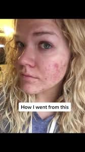 The Ordinary and Neutrogena Is It Going to Make Chemical Correction