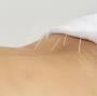 Start Physio, Acupuncture from dynamicphysio.co.nz