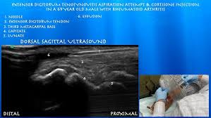 Image result for Tendon Sheath Injection