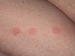 Image result for mosquito bite