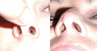 Whatever you need, whatever you want, whatever you desire, we provide. Revision Rhinoplasty Nyc Dr Garrett Bennett Ny Sinus Rhinoplasty Surgeon