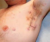 The lesions are located in both the left and right axilla areas. Laser Assisted Hair Removal Procedure Beneficial For Treatment Of Hidradenitis Suppurativa