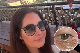 I was left with singed eyelashes & sores