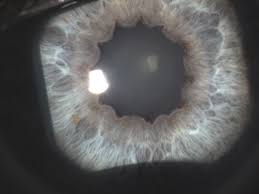 0 ratings0% found this document useful (0 votes). Paramiloidose Ocular Um Caso Clinico Oftalpro