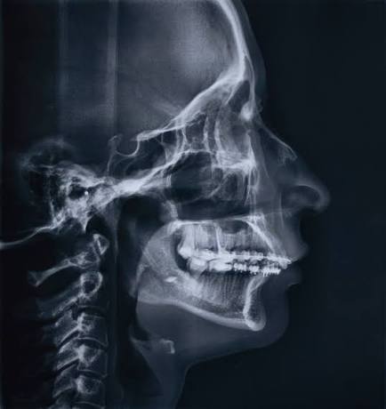 Unlocking Smiles: The Essential Guide to Cephalometric X-Rays in Modern  Dentistry | Coastal Kids