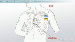 A defibrillator works by resetting and jump starting the electric cycle of your heart. Aicd Medical Abbreviation Definition Indications Placement Video Lesson Transcript Study Com