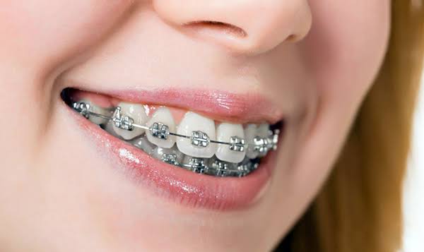 Niềng răng mắc cài