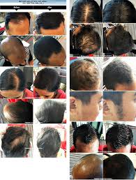 It would be best if you didn't use any toppik, dermmatch, couvre, or other forms of hair loss concealers during this time. Oh Fish Iee Toppik Your Hair Loss Solution