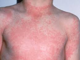 La scarlattina, a differenza della altre malattie esantematiche come il morbillo o la rosolia, non dà immunità una volta contratta: Scarlattina Sintomi Contagio E Cure In Bambini E Adulti Foto Greenme
