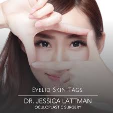 The ultraviolet radiation or uv rays given off by the sun can mutate skin cells and turn them cancerous. Eyelid Skin Tags New York Eyelid Surgeon Dr Jessica Lattman