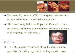 Skin cancer is by far the most common type of cancer. Xeroderma Pigmentosum