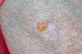 Image result for Oncinotis