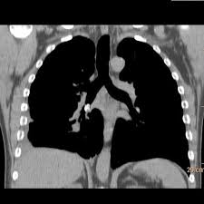 Image result for Broncholithiasis