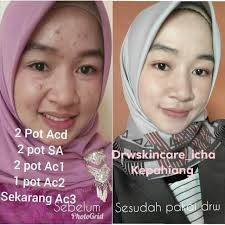 Alhamdulillah Testimoni Dari Drw Skincare By Dr Wahyu Triasmara Facebook