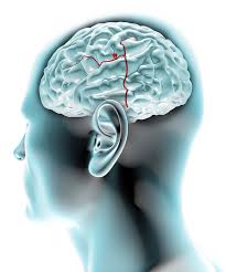 Aneurisma analytical causas sintomas y tratamiento. Desarrollan Dispositivos Tipo Estent Para Aneurismas Cerebrales