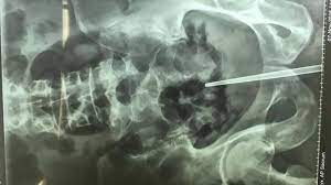 Maksiat kemaluan melakukan maksiat kemaluan adalah dosa besar. Dokter Bingung Sumpit Masuk Dalam Kemaluan Pria Ini Hingga Harus Dioperasi Tribun Medan