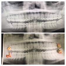 Wisdom Teeth Extraction Wisdom Teeth Removal Wisdom Teeth Wisdom Teeth Removal Procedure