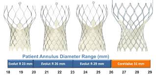 Corevalve Sizing