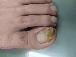You can know for sure that you have fungus and of the black variety from pictures. Toenail Fungus Treatment Laser Beaver Valley Foot Clinic